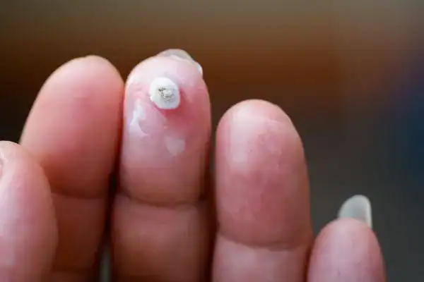 Image of white wart before cryopen treatment Redhill