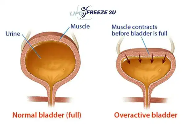 diagram of overactive bladder treatment Redhill