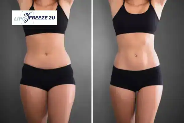 How Can LIPO FREEZE 2U Support Your Post-Pregnancy Body Recovery Redhill?