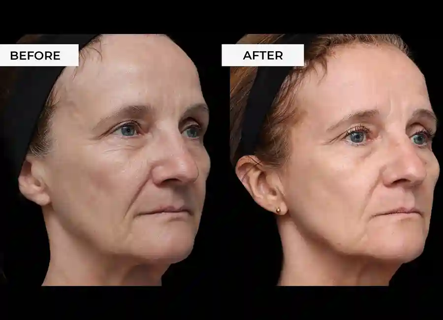 How Many RF Microneedling Sessions Will You Need to See a Difference Redhill?