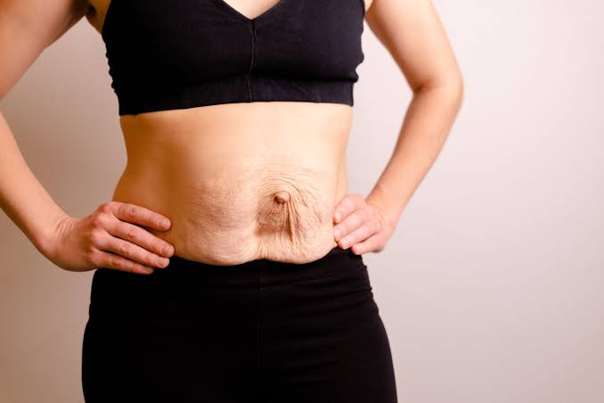 Is Surgery Really the Only Way to Repair Diastasis Recti Redhill?