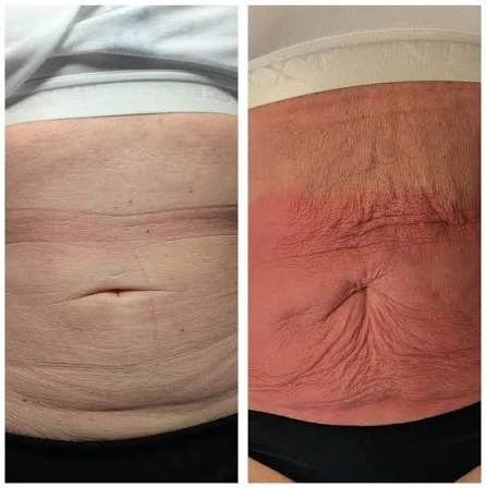 How Does RF Microneedling Improve Crepey, Thin and Uneven Skin Texture Redhill?