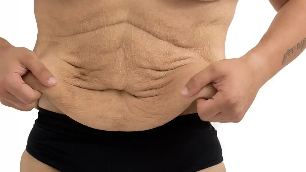 RF Microneedling for Loose Skin: How Can It Help Tighten and Reshape the Skin Redhill?